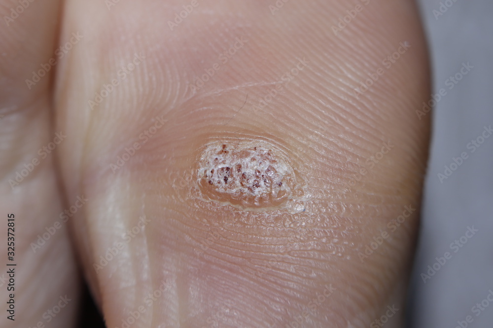 HPV Close-up shot of a plantar wart on the bottom of the big toe caused by the human papillomavirus. HPV Close-up shot of a plantar wart on the bottom of the big toe caused by the human papillomavirus.