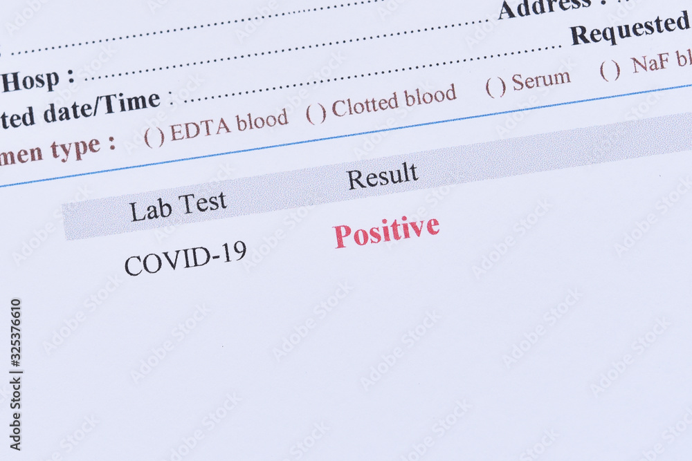 Positive test result of COVID-19, novel coronavirus 2019 found in Wuhan, China Positive test result of COVID-19, novel coronavirus 2019 found in Wuhan, China