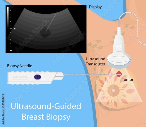 Biopsy needle examination treatment diagnosis Medical