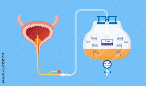 Urine bag medical treatment drainage bladder rubber flexible body infection bacteria output measure tract toilet leg relieve cancer device calculi vesical problem anatomy sterile surgical urethra