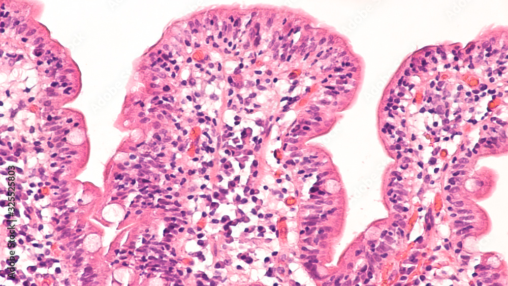 Histology of duodenal biopsy from patient with bloating and diarrhea