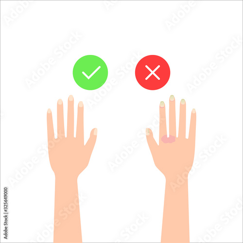 two hands - healthy and with nail disease