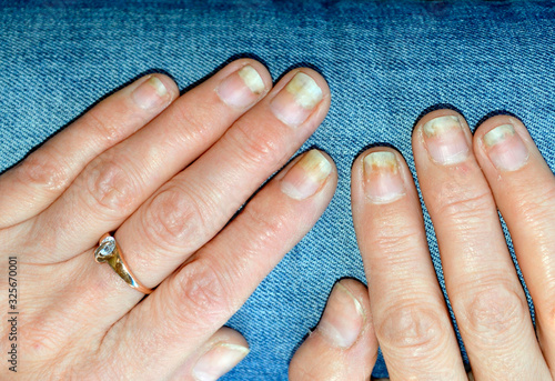 Fungal nail infection, onycholysis after shellac or gel-varnish. photo
