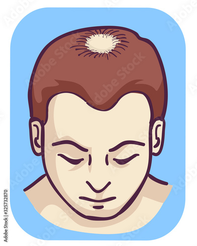 Man Pattern Baldness Hair Loss Vertex Illustration