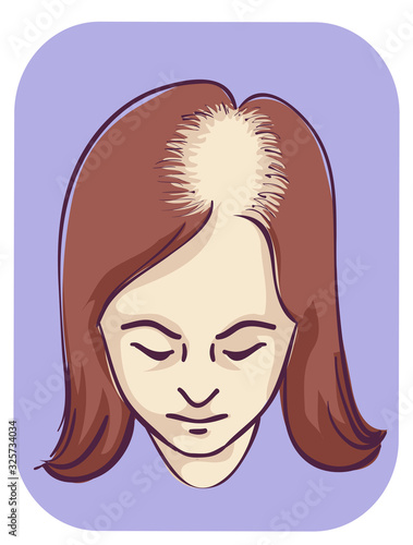 Girl Female Pattern Baldness Frontal Scalp