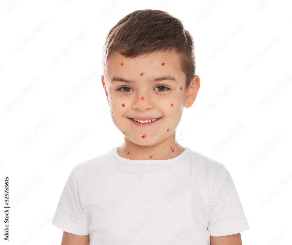 Little boy with chickenpox on white background Little boy with chickenpox on white background