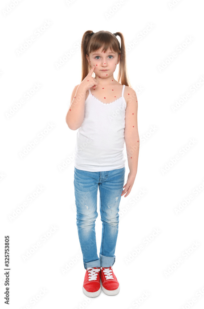 Little girl with chickenpox on white background Little girl with chickenpox on white background