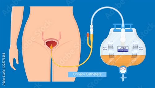 Urine bag medical treatment drainage bladder rubber flexible body infection bacteria output measure tract toilet leg relieve cancer device calculi vesical problem anatomy sterile surgical urethra