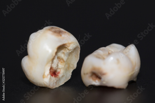 tooth decayed caries on a black background
