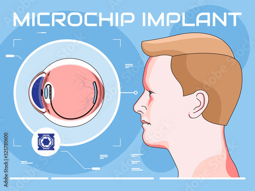 Vector illustration of modern micro eye implantation