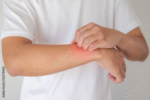 man itching and scratching on arm from itchy dry skin eczema dermatitis