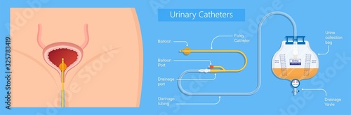 Urine bag medical treatment drainage bladder rubber flexible body infection bacteria output measure tract toilet leg relieve cancer device calculi vesical problem anatomy sterile surgical urethra