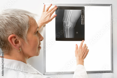 Radiologist examined a knee x-ray on a negatoscope. Doctor sees a bruised leg in an x-ray photograph