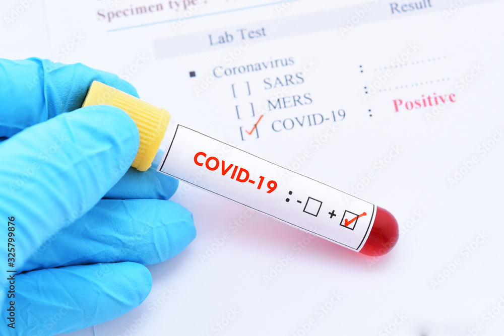 Obraz premium Blood sample tube positive with COVID-19 or novel coronavirus 2019 found in Wuhan, China