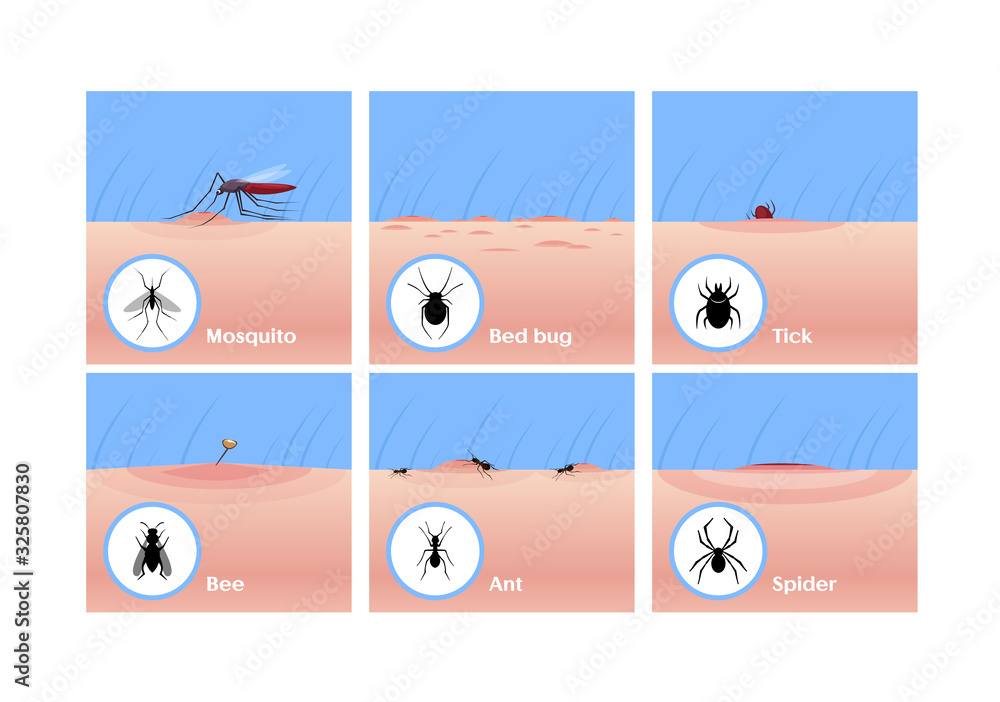 Insect bites flat vector illustrations set. Mosquito drinking blood, tick getting under skin