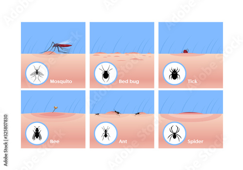 Insect bites flat vector illustrations set. Mosquito drinking blood, tick getting under skin, bee sting. Bed bug, ant and spider bites. Skin lesion, wound and inflammation, allergic reaction.