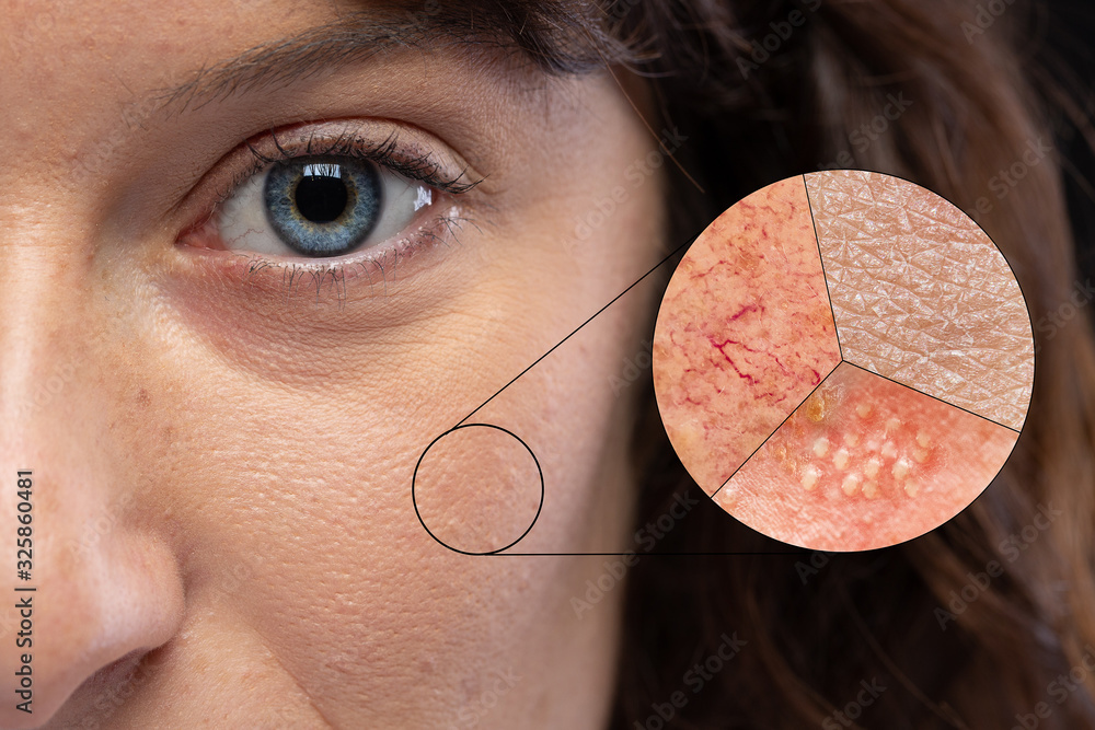 Enlarged view of the skin showing redness for rosacea, dry skin and