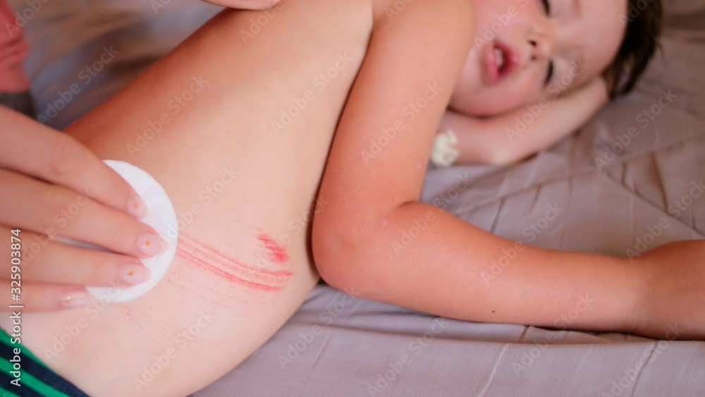 From above faceless mom disinfecting scrape on tummy of son lying on bed at home From above faceless mom disinfecting scrape on tummy of son lying on bed at home