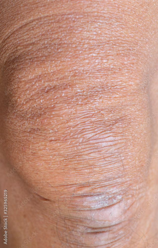 Wrinkles and rough skin on the knees Wrinkles and rough skin on the knees