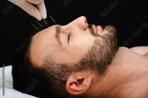 Foto Acupuncture treatment to relieve stress and relax the body man