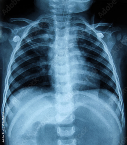 x- ray of chest