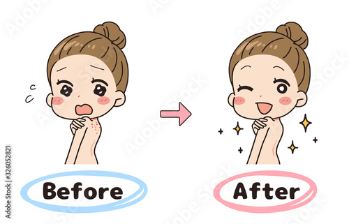 Set illustration of before and after back acne, upper body.