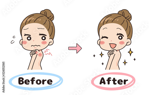 Set illustration of before and after sunburn, upper body.