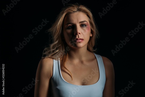 Woman with bruises on face looking at camera isolated on black
