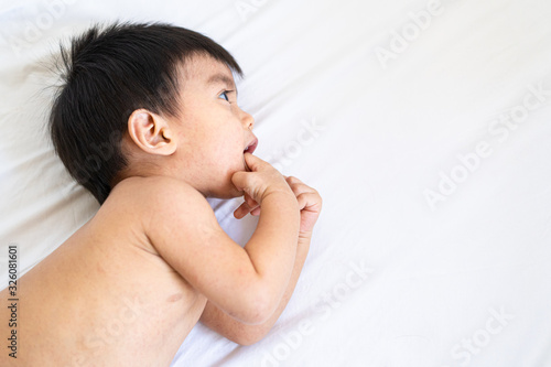A cute asian little baby boy is laying on the bed while he has skin problem from viral infection  concept of healthcare  illness and skin problem in pediatric.