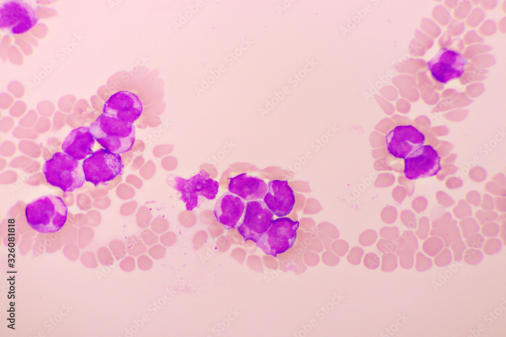 Acute promyelocytic leukemia cells or APL, analyze by microscope, original magnification 1000x