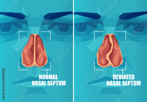 Vector cross section of face with deviated and normal nasal septum