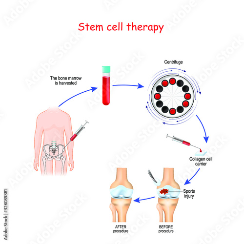 Stem cell therapy. Before and after of Sports injury. human knee joint