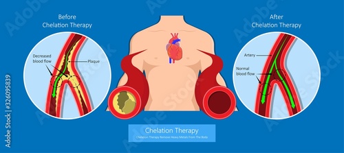 Chelation Therapy lead mercury iron arsenic ethylenediaminetetraacetic acid bloodstream coronary artery disease metal poisoning autism Alzheimer’s diabetes inject agent arteries iv toxic treat vein