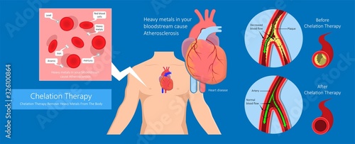 Chelation Therapy lead mercury iron arsenic ethylenediaminetetraacetic acid bloodstream coronary artery disease metal poisoning autism Alzheimer’s diabetes inject agent arteries iv toxic treat vein