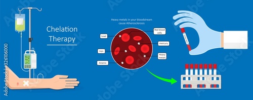 Chelation Therapy lead mercury iron arsenic ethylenediaminetetraacetic acid bloodstream coronary artery disease metal poisoning autism Alzheimer’s diabetes inject agent arteries iv toxic treat vein
