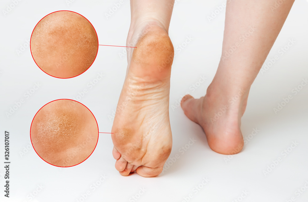 Fotka „Female feet with corns and calluses, on a white background. Foot
