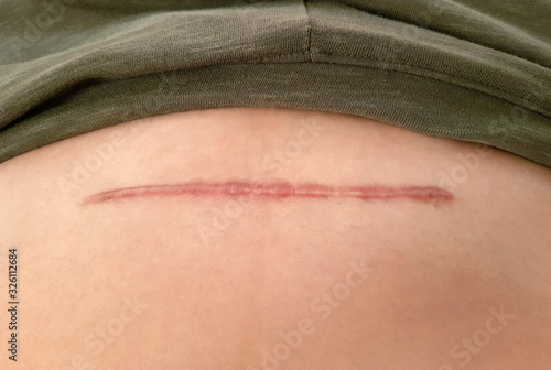 Close up cesarean section scar on woman belly.