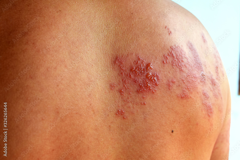 Fototapeta premium Shingles (Disease),Herpes zoster, severe dermatitis due to a viral infection and blisters on body