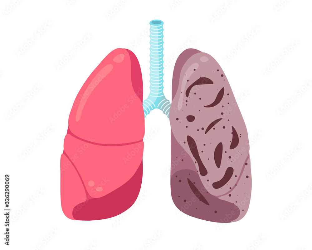 Sick unhealthy lungs tuberculosis infection disease. Human respiratory system internal organ tubercle bacillus infected or pneumonia struck. Medical anatomy inflammation damage vector illusrtation Sick unhealthy lungs tuberculosis infection disease. Human respiratory system internal organ tubercle bacillus infected or pneumonia struck. Medical anatomy inflammation damage vector illusrtation