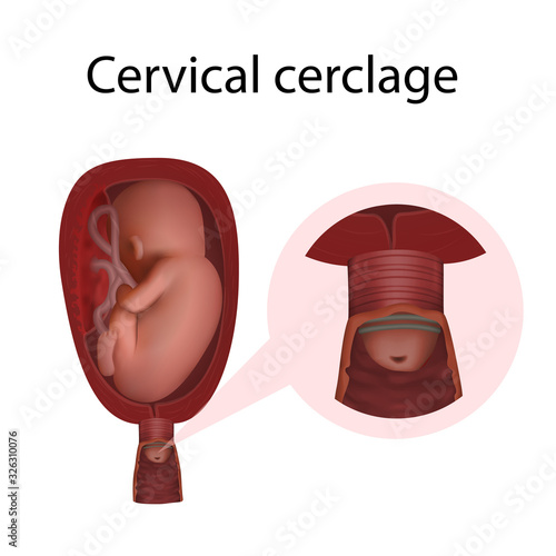 Cervical cerclage. Cervical weakness. Fetus in uterus, womb, placenta, umbilical cord. Hi-risk pregnancy complications. Medical anatomy illustration.