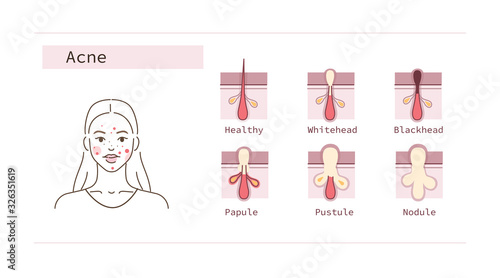 Beauty Girl Have Acne Skin Problems. Skin Layers with different Acne Types. Open and Closed Facial Comedones, Papule, Pustule. Epidermis Tissue Inflammation. Flat Vector Illustration and Icons set.