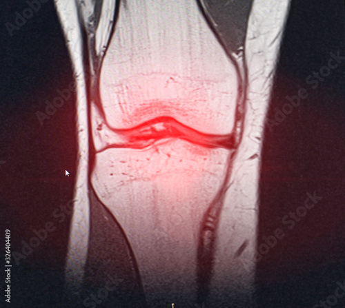 A snapshot of the diagnosis of an MRI of the knee in which arthrosis and arthritis. The concept of joint diagnosis using x-rays, treatment of diseases of the knee joint, bursitis