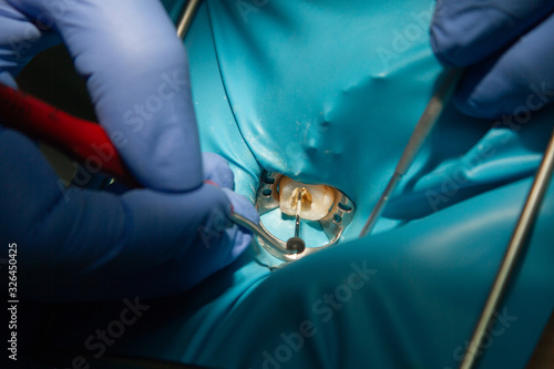 Fotografie Treatment of dental canals in the upper molar permanent molar using an apex locator file, a tooth with a clip attached to it with a cofferdam