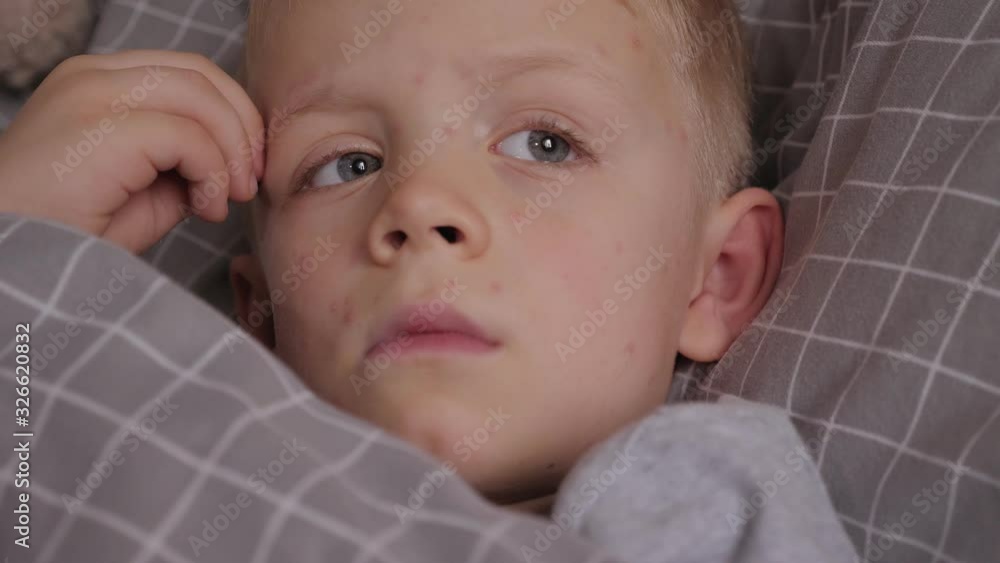 A little boy with chickenpox is lying in bed and scratching the skin on