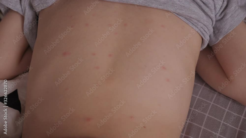 A little boy with chickenpox is lying on a bed at home. The child has a ...