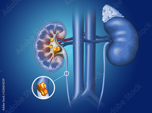 Kidney stones in kidney and ureter, medically illustration photo