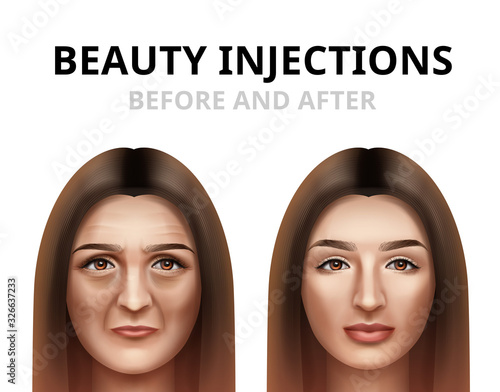 Realistic before and after vector illustration of woman having facial beauty injection.