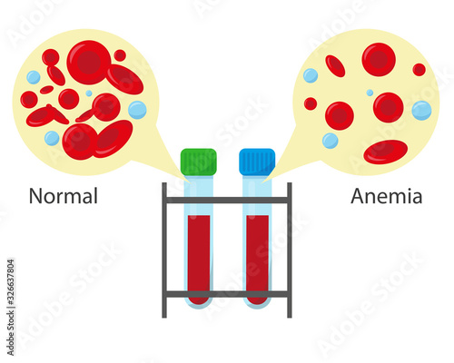 Tubes with normal blood and leukemia blood for medical concept. Blood analysis or leukemia test banner. Vector illustration.