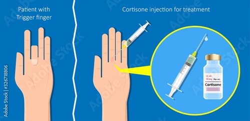 Cortisone shots injection epidural steroid ESI lumbar back spinal nerves anti inflammatory Carpal Tunnel Syndrome tennis elbow symptom swelling chronic discomfort