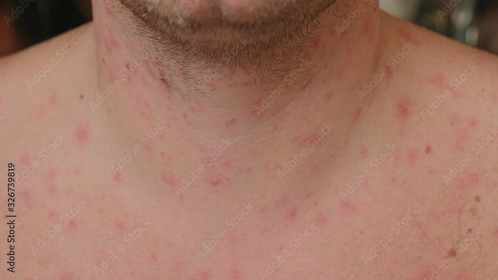 Close-up of skin with red rashes from chickenpox. The neck and chest of an adult male with blisters from chickenpox. Man is chickenpox, he problematic skin and scars from acne. Close-up of skin with red rashes from chickenpox. The neck and chest of an adult male with blisters from chickenpox. Man is chickenpox, he problematic skin and scars from acne.